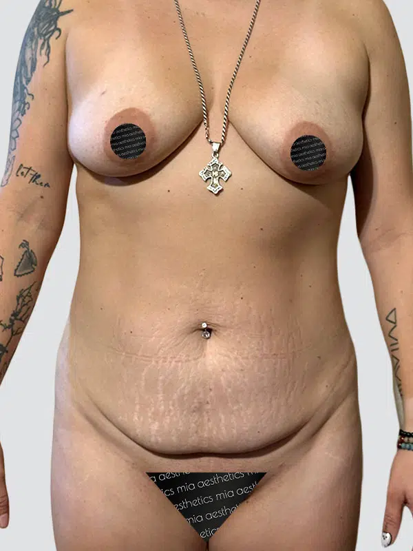 Mommy Makeover before photo – Mia Aesthetics