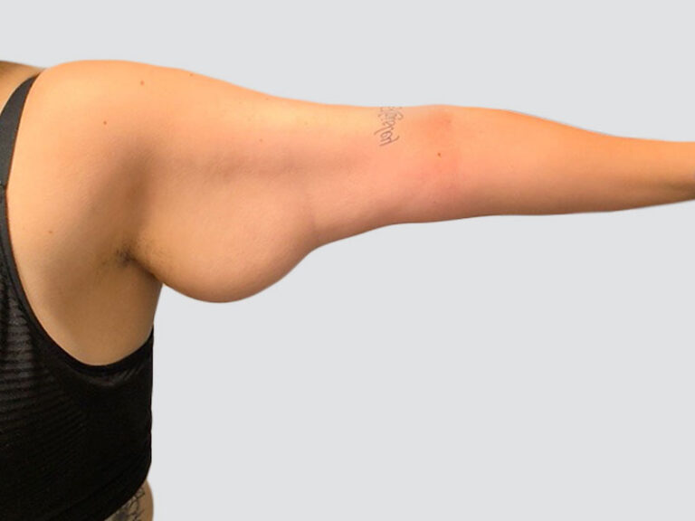 Before Treatment – Case 6005 – Arm Lift