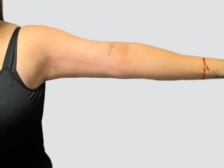 After Treatment – Case 6005 – Arm Lift