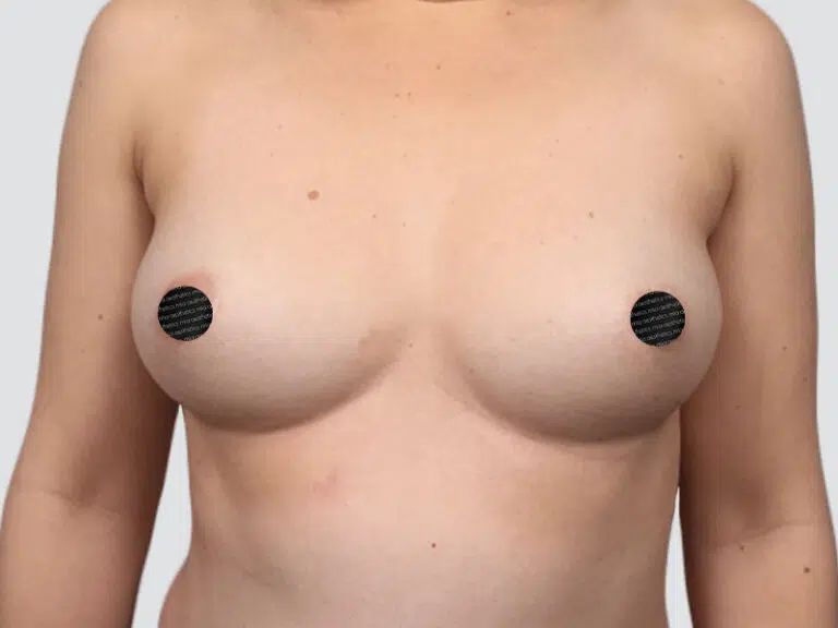 Breast Augmentation before photo – Mia Aesthetics