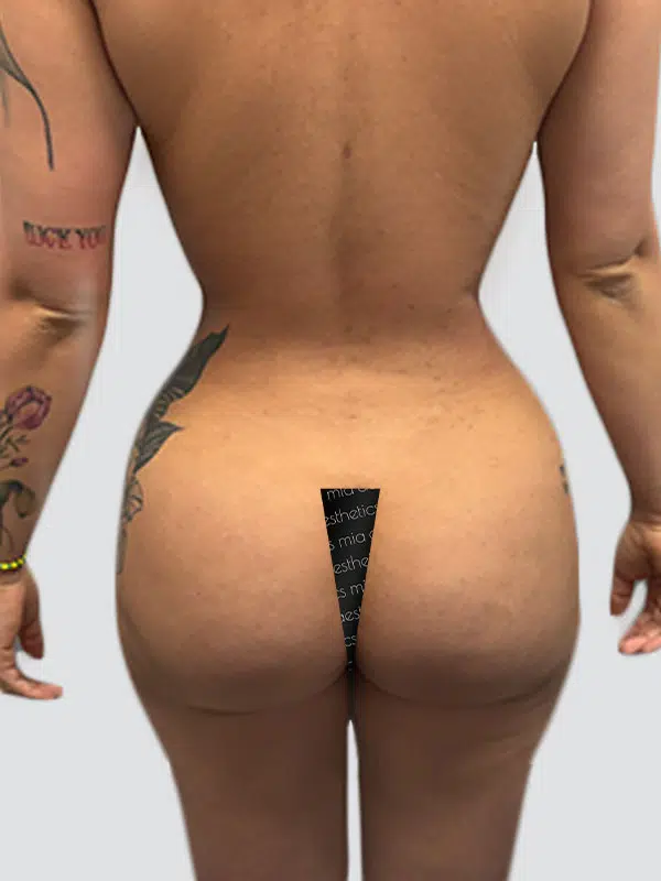 Brazilian Butt Lift (BBL) after photo – Mia Aesthetics