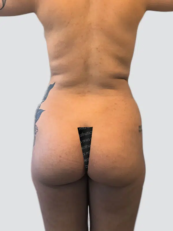 Brazilian Butt Lift (BBL) before photo – Mia Aesthetics