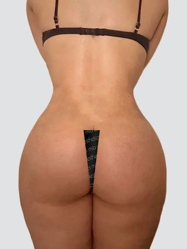 Brazilian Butt Lift (BBL) after photo – Mia Aesthetics
