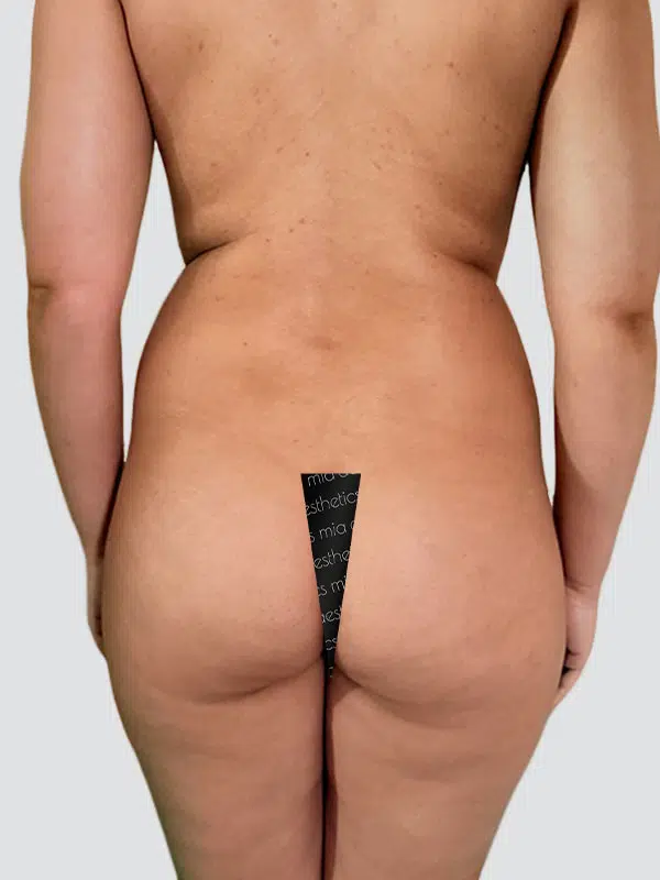 Brazilian Butt Lift (BBL) before photo – Mia Aesthetics