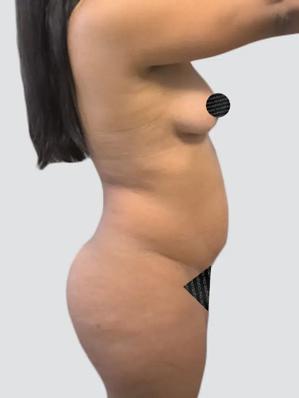 Lipo 360 before photo – Mia Aesthetics