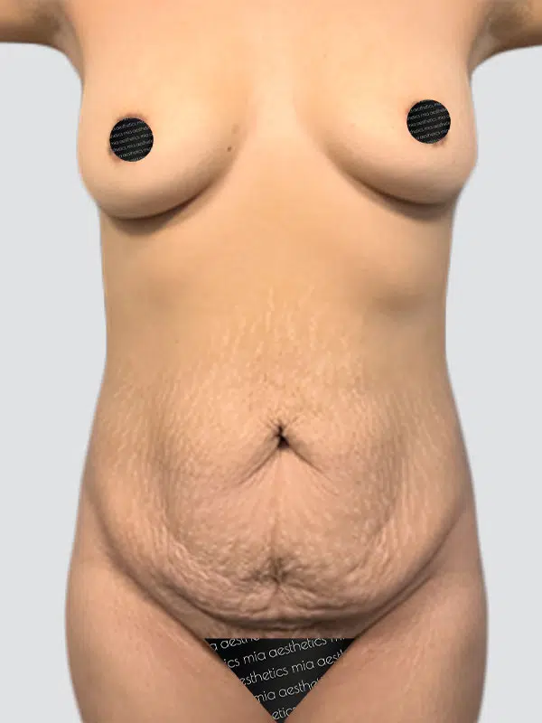 Tummy Tuck before photo – Mia Aesthetics
