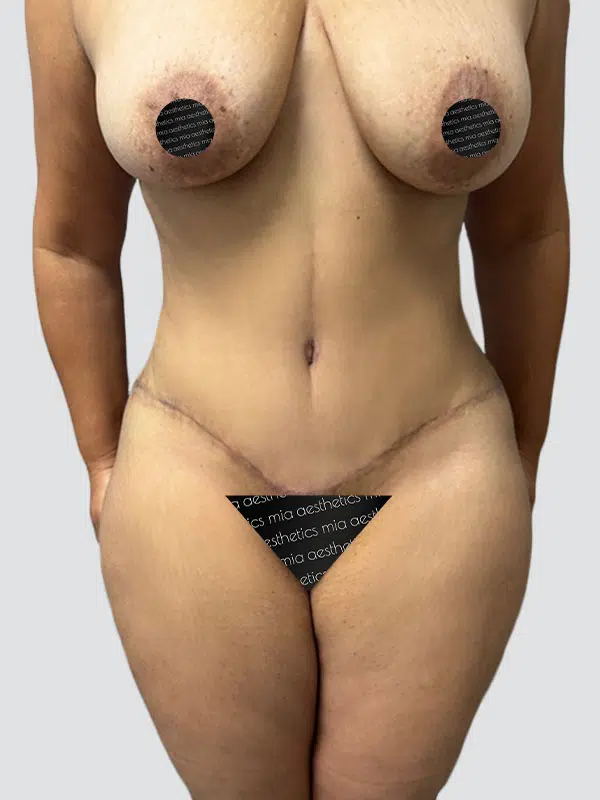 Tummy Tuck after photo – Mia Aesthetics