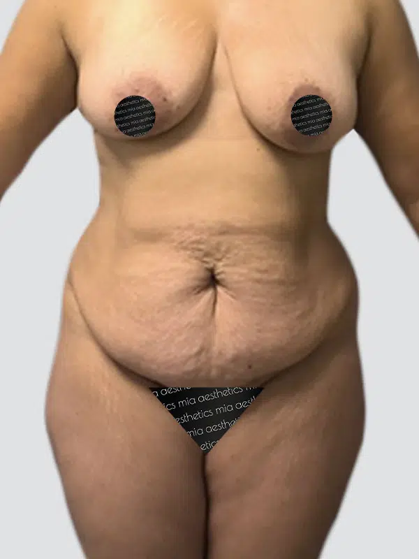 Tummy Tuck before photo – Mia Aesthetics