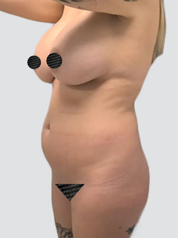 Brazilian Butt Lift (BBL) before photo – Mia Aesthetics