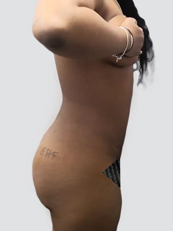 Lipo 360 after photo – Mia Aesthetics