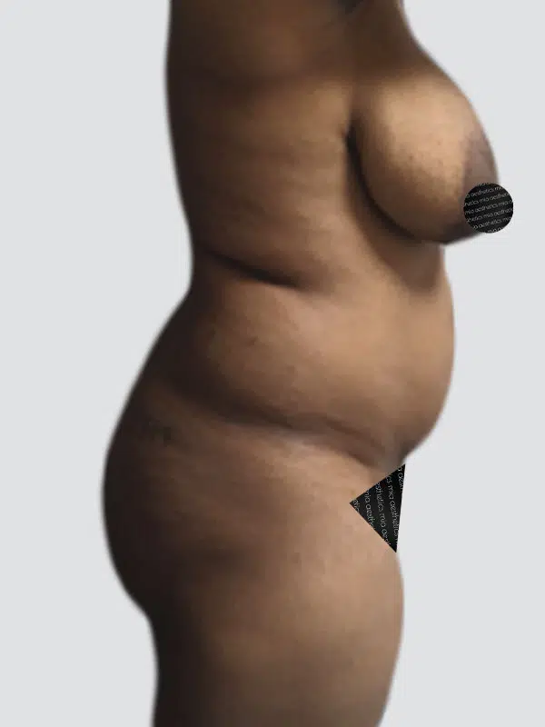 Lipo 360 before photo – Mia Aesthetics