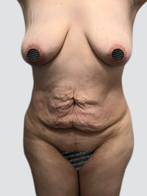 Tummy Tuck before photo – Mia Aesthetics