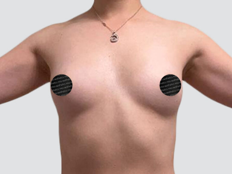 Before Treatment – Case 2020 – Breast Augmentation