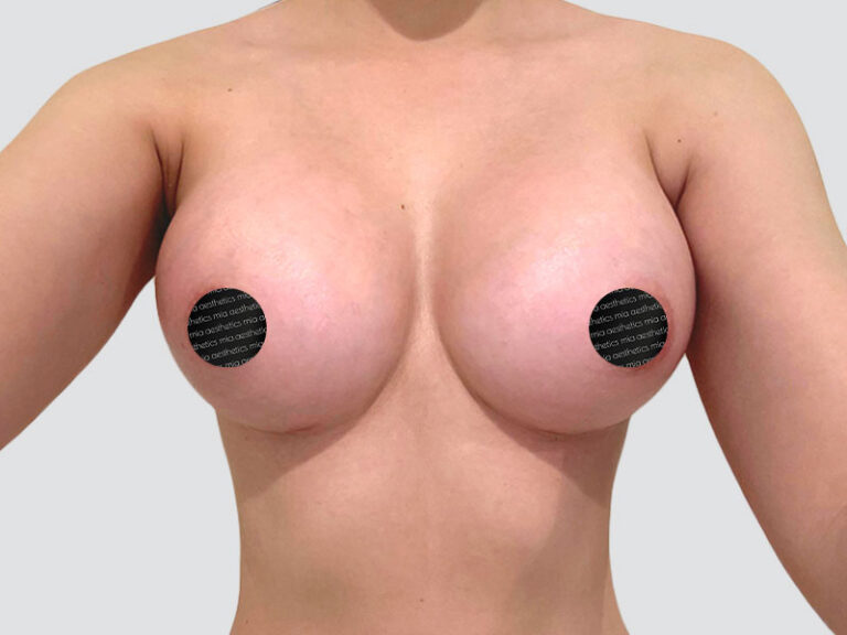 After Treatment – Case 2020 – Breast Augmentation