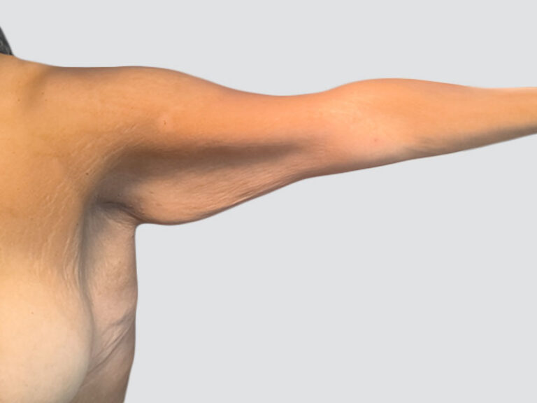Before Treatment – Case 6007 – Arm Lift
