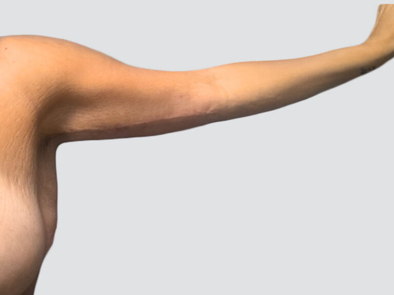 After Treatment – Case 6007 – Arm Lift