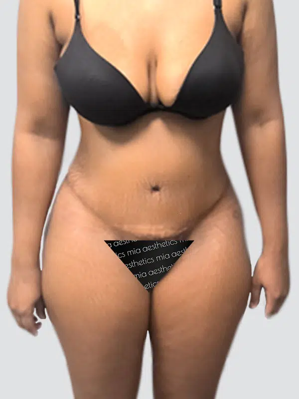Tummy Tuck after photo – Mia Aesthetics