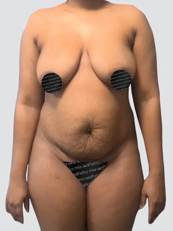 Tummy Tuck before photo – Mia Aesthetics