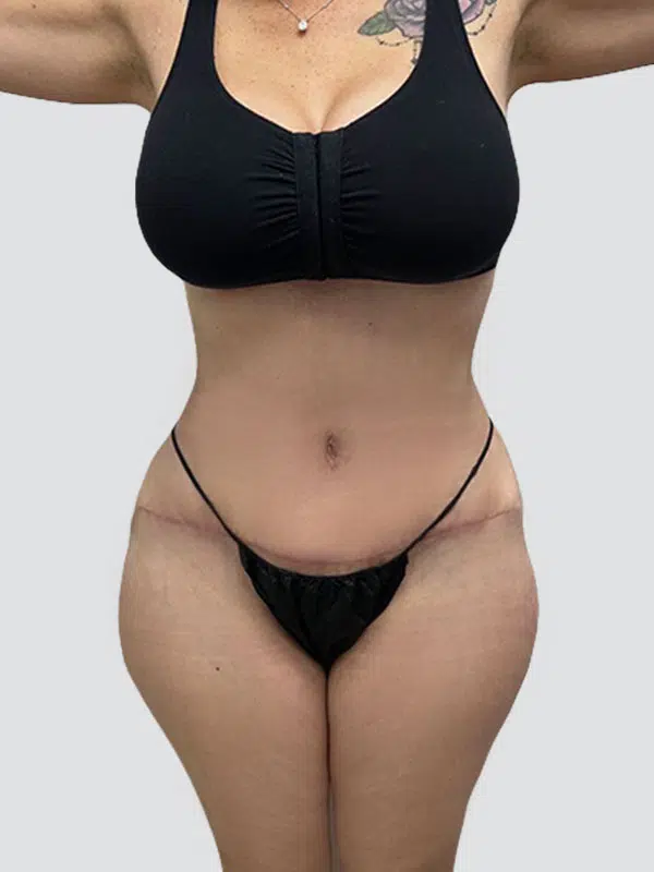 Tummy Tuck after photo – Mia Aesthetics