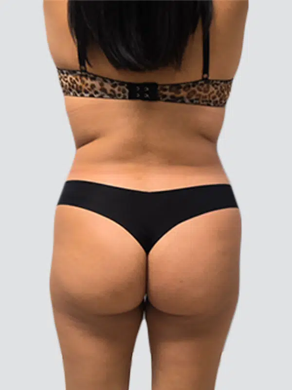 Brazilian Butt Lift (BBL) before photo – Mia Aesthetics