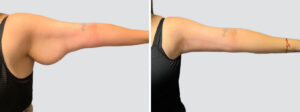 Case 6005 – Arm Lift