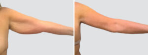 Case 6006 – Arm Lift