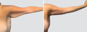 Case 6007 – Arm Lift