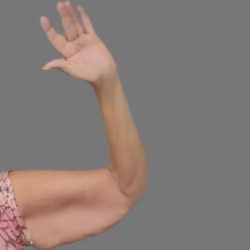 Arm Lift before photo – Mia Aesthetics