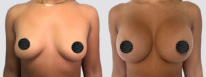 Case 2016 – Breast Augmentation