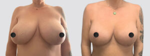 Case 2002 – Breast Reduction