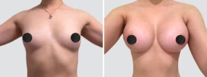 Case 2020 – Breast Augmentation