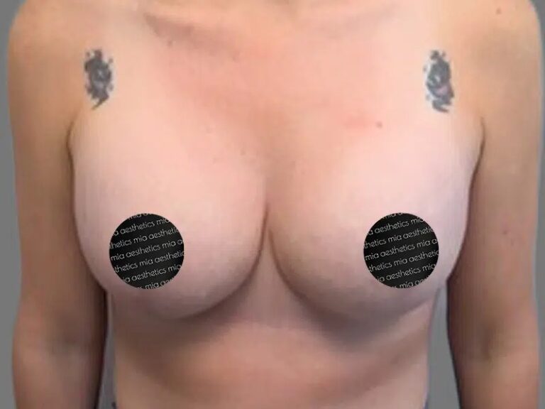 After Treatment – Case 2003