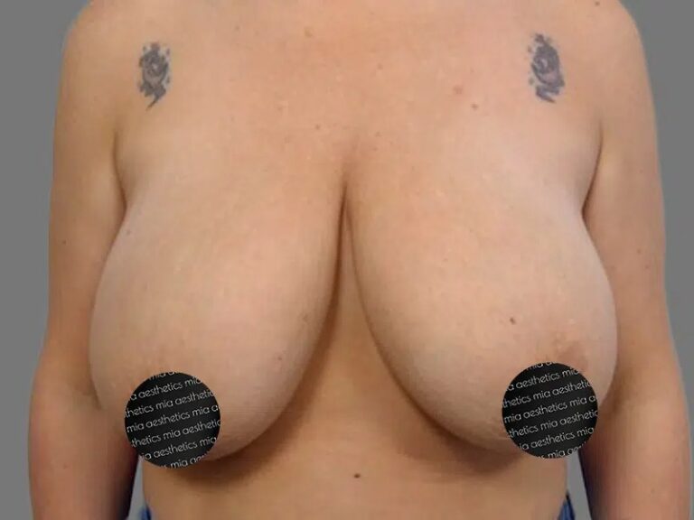 Before Treatment – Case 2003