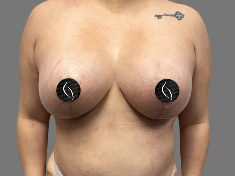 After Treatment – Case 1999 – Breast Lift with Silicone Implants