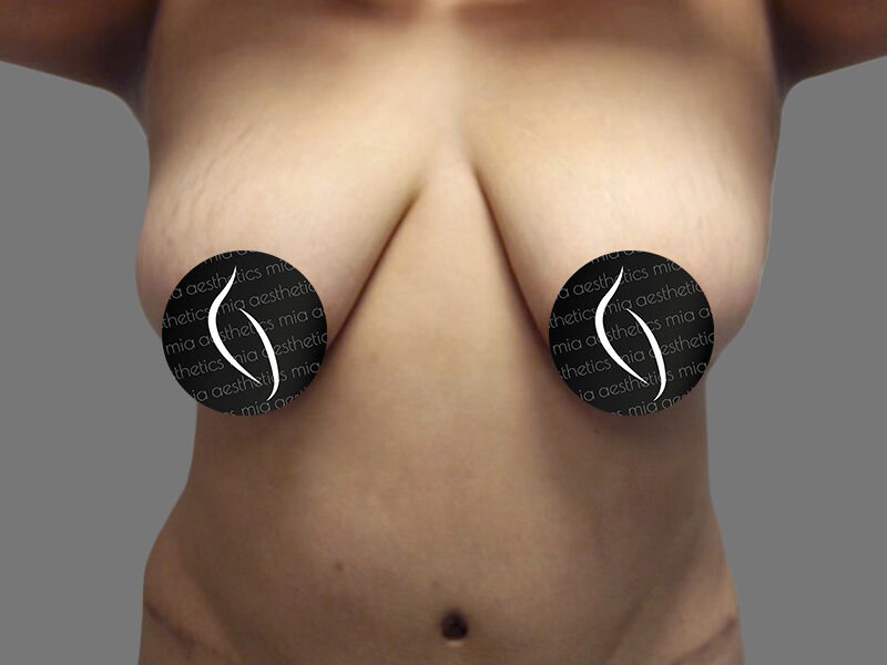 Before Treatment – Case 1999 – Breast Lift with Silicone Implants