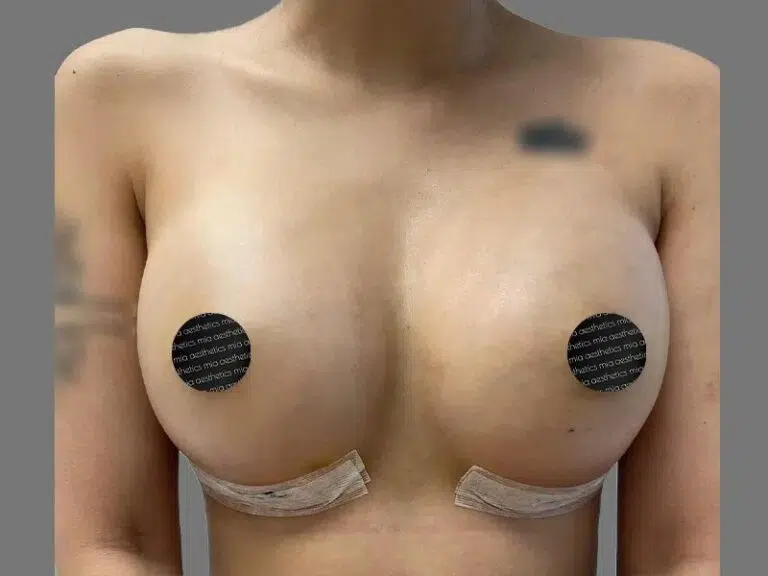 Breast Augmentation after photo – Mia Aesthetics