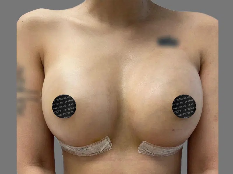 After Treatment – Case 2000