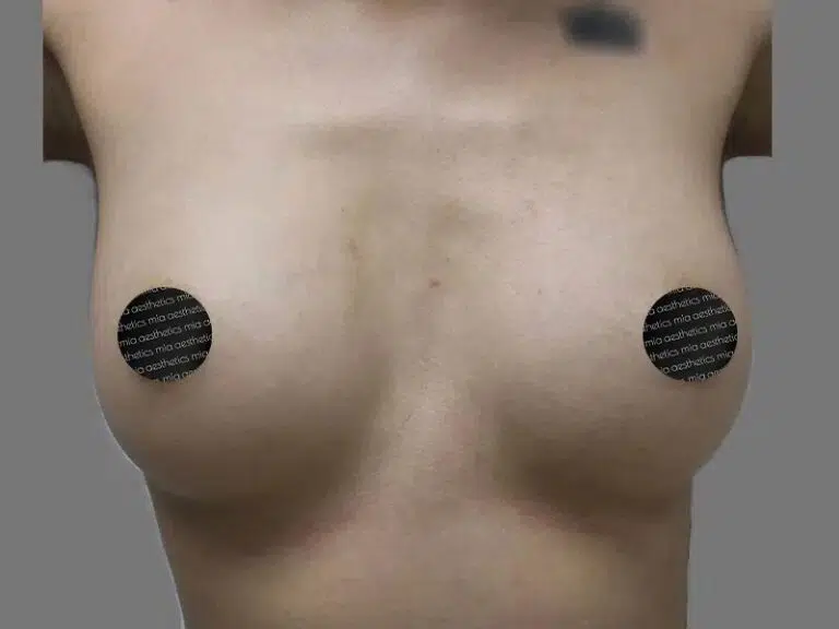 Breast Augmentation before photo – Mia Aesthetics