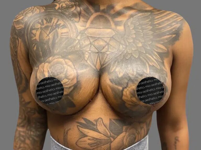 After Treatment – Case 2001 – Breast Reduction