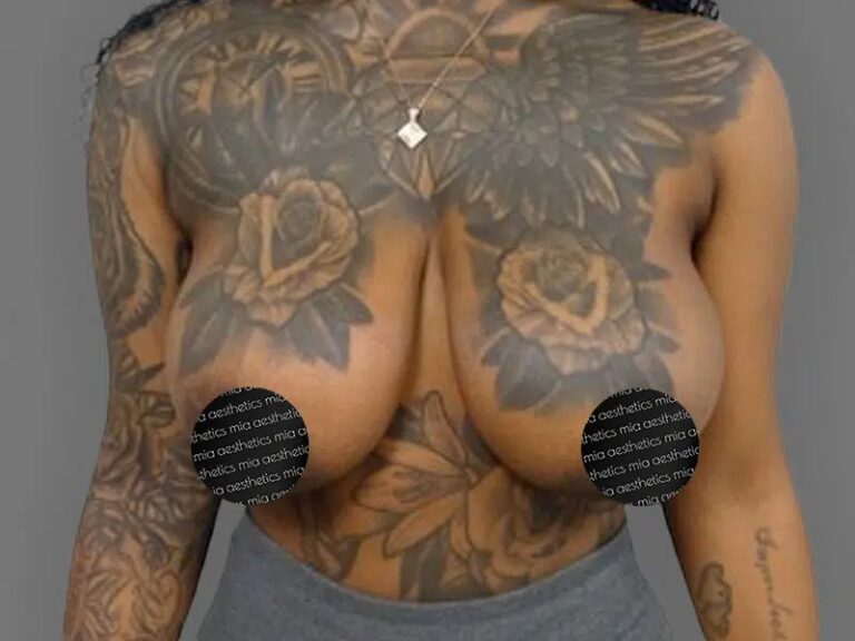 Before Treatment – Case 2001 – Breast Reduction