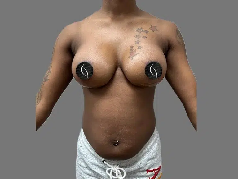 Breast Augmentation after photo – Mia Aesthetics