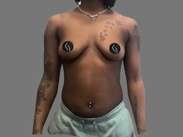Breast Augmentation before photo – Mia Aesthetics