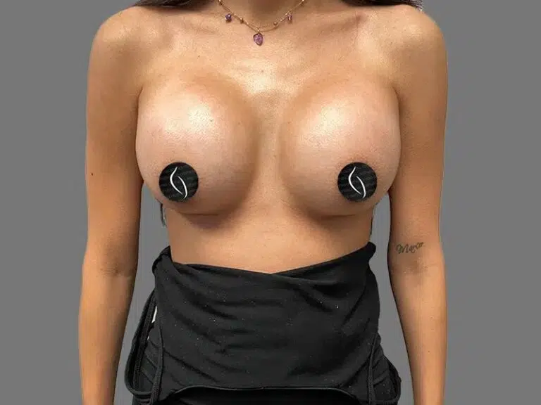 Breast Augmentation after photo – Mia Aesthetics