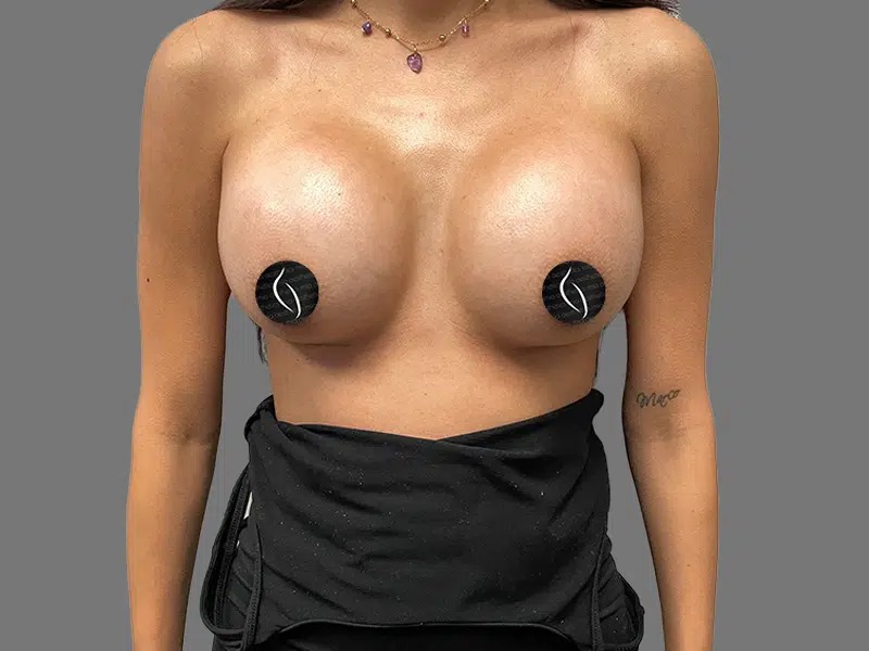 After Treatment – Case 2005