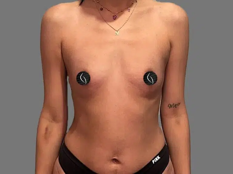 Breast Augmentation before photo – Mia Aesthetics