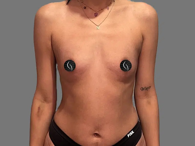 Before Treatment – Case 2005