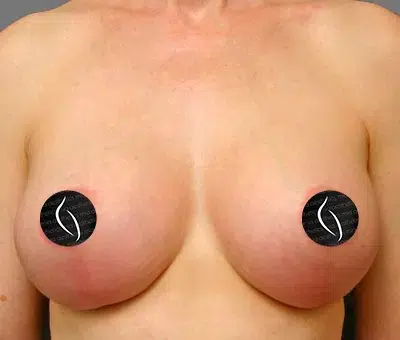 Breast Lift after photo – Mia Aesthetics