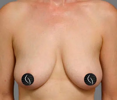 Before Treatment – Case 2008