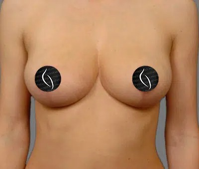 After Treatment – Case 2009