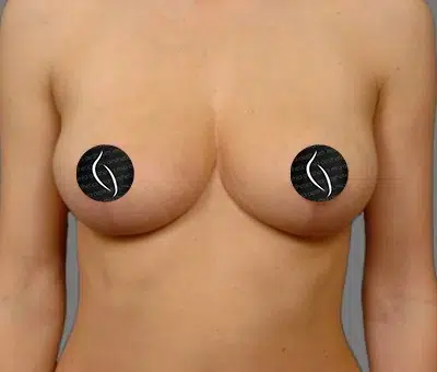 Breast Lift after photo – Mia Aesthetics